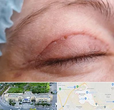 جراح پلک در نسیم شهر