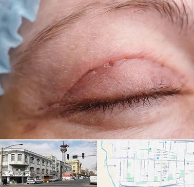 جراح پلک در 17شهریور