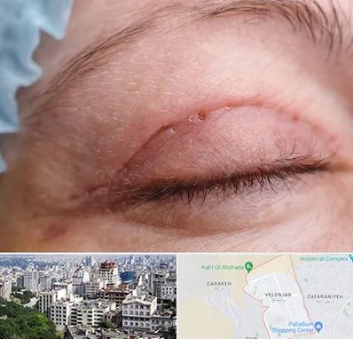 جراح پلک در ولنجک 