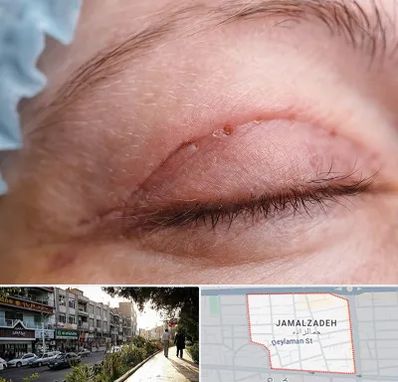 جراح پلک در خیابان جمالزاده