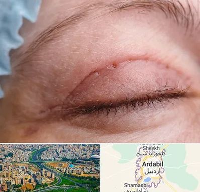 جراح پلک در اردبیل