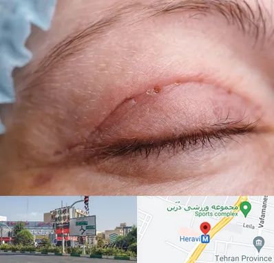 جراح پلک در هروی 
