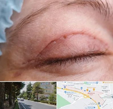 جراح پلک در مهرویلا کرج