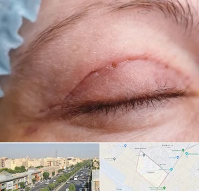 جراح پلک در کیانمهر کرج