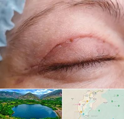 جراح پلک در رودبار