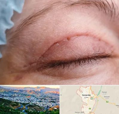 جراح پلک در سنندج