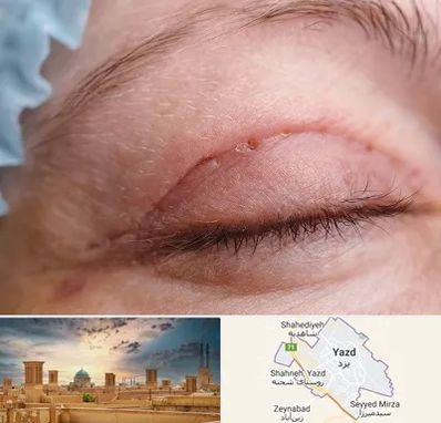 جراح پلک در یزد