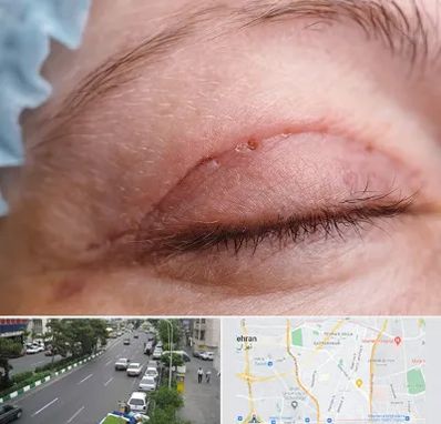 جراح پلک در ستارخان 