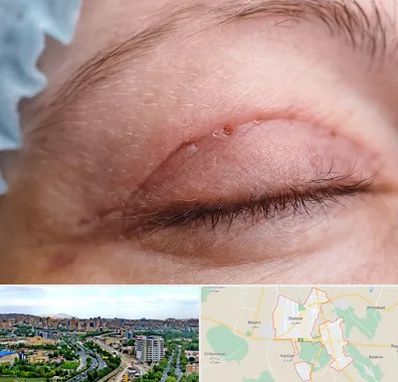 جراح پلک در شهریار