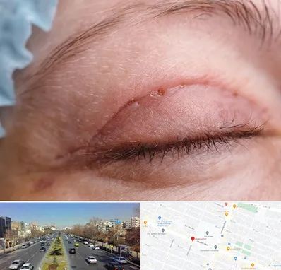 جراح پلک در بلوار معلم مشهد 