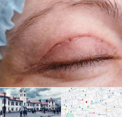 جراح پلک در میدان شهرداری رشت