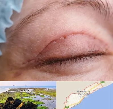 جراح پلک در بندرلنگه