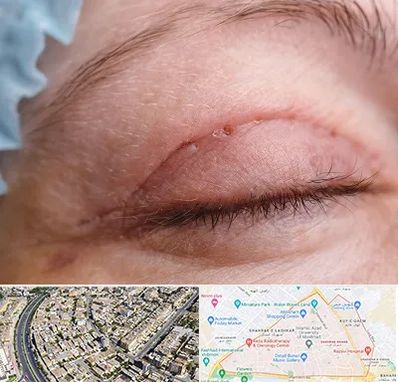 جراح پلک در شهرک غرب مشهد