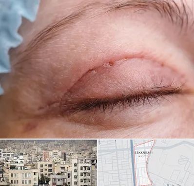 جراح پلک در اسکندری