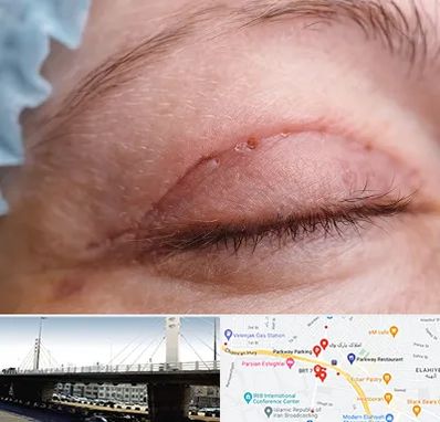 جراح پلک در پارک وی 