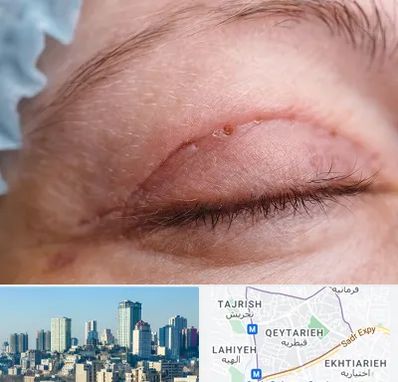 جراح پلک در قیطریه 