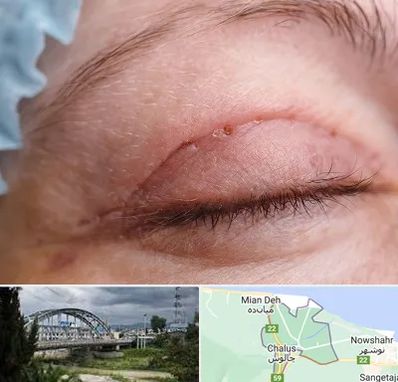 جراح پلک در چالوس