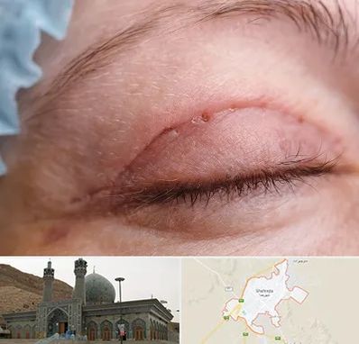 جراح پلک در شهرضا