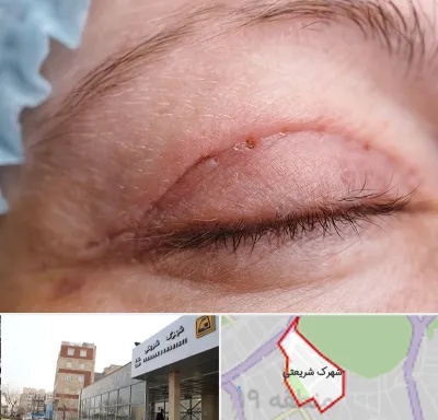 جراح پلک در شهرک شریعتی