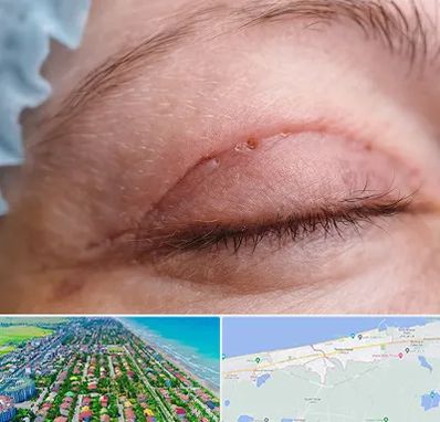 جراح پلک در فریدونکنار