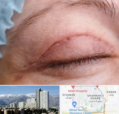 جراح پلک در شهرک غرب 