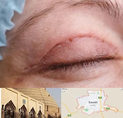 جراح پلک در ساوه
