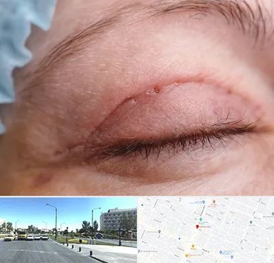 جراح پلک در بلوار کلاهدوز مشهد 