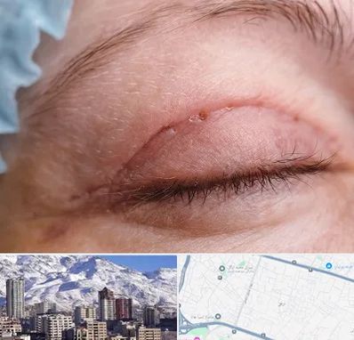 جراح پلک در ازگل