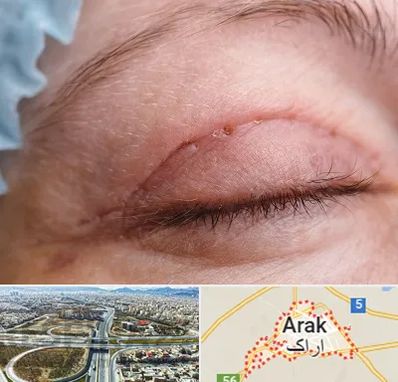 جراح پلک در اراک