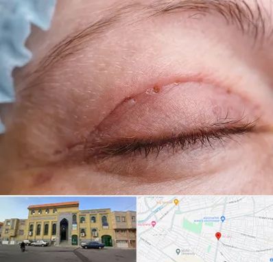 جراح پلک در زنبیل آباد قم