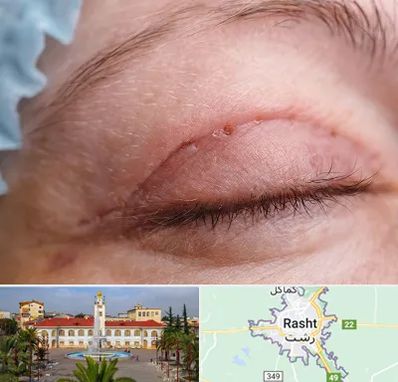 جراح پلک در رشت