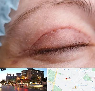 جراح پلک در بلوار سجاد مشهد 