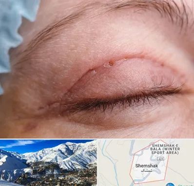 جراح پلک در شمشک