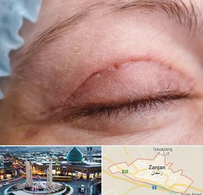 جراح پلک در زنجان