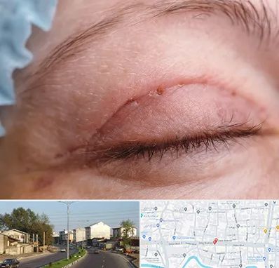 جراح پلک در ضیابری رشت