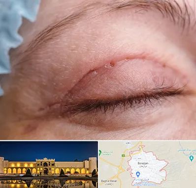 جراح پلک در برازجان