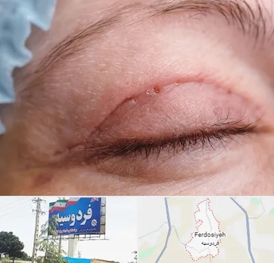 جراح پلک در فردوسیه شهریار