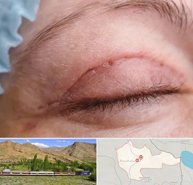 جراح پلک در خاش