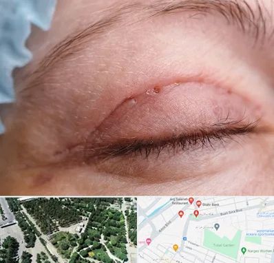 جراح پلک در سالاریه قم