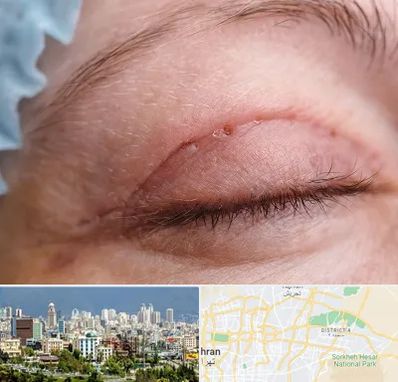 جراح پلک در شرق تهران 