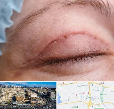 جراح پلک در شهرک راه آهن