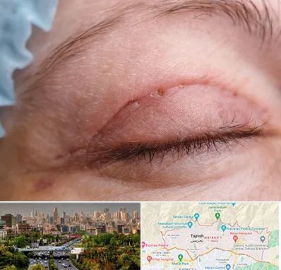 جراح پلک در منطقه 1 تهران 