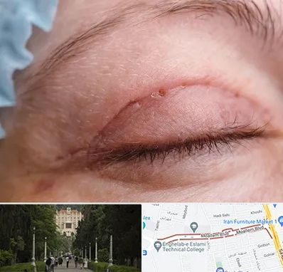 جراح پلک در بلوار معلم رشت 