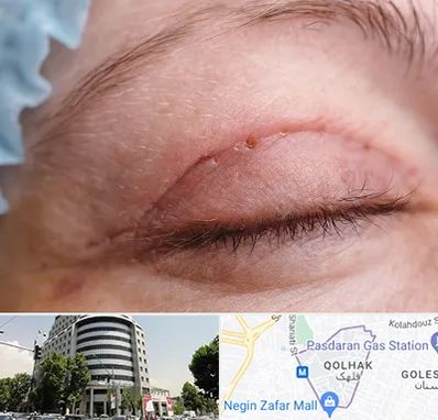 جراح پلک در قلهک 