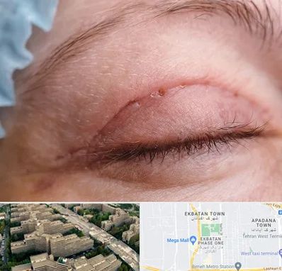 جراح پلک در اکباتان 