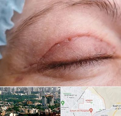 جراح پلک در عظیمیه کرج 