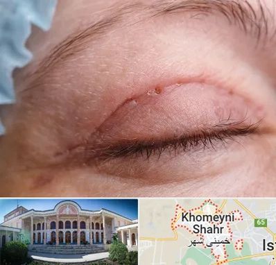 جراح پلک در خمینی شهر