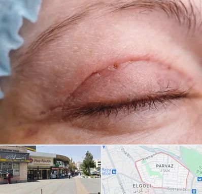 جراح پلک در پرواز تبریز