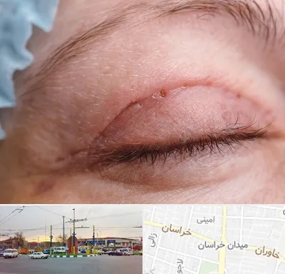 جراح پلک در میدان خراسان