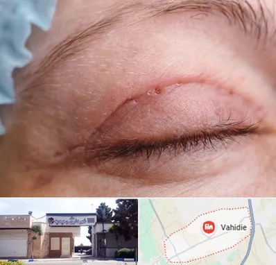 جراح پلک در وحیدیه شهریار